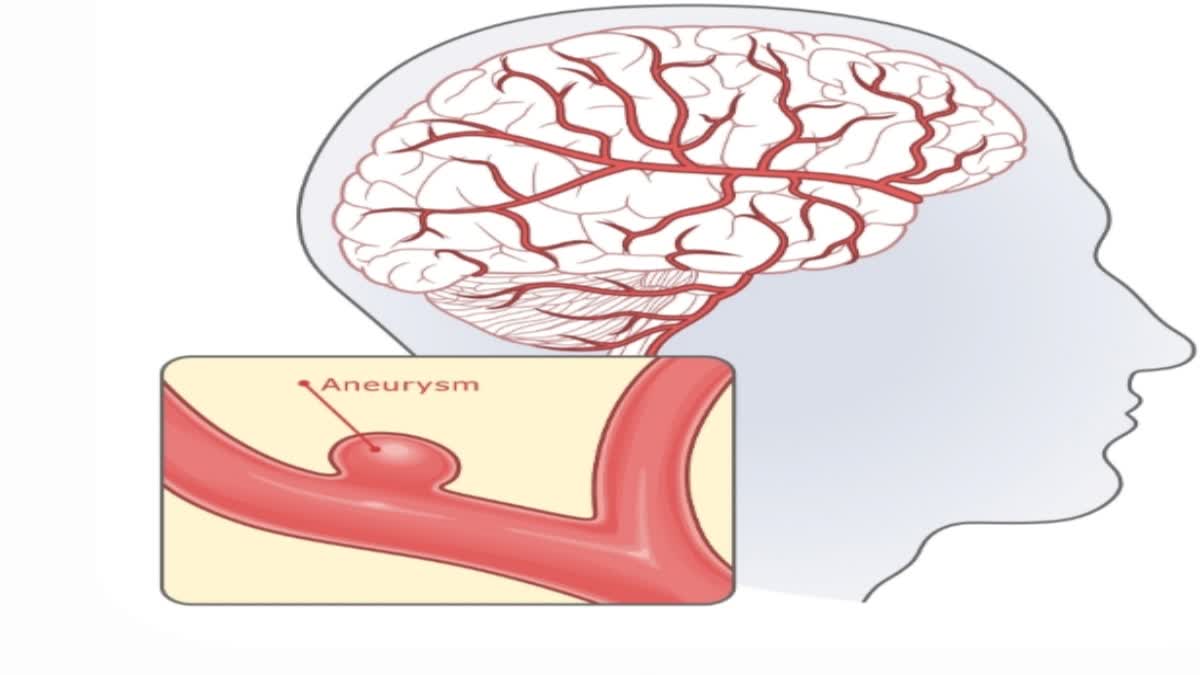 CUSAT  CEREBRAL ANEURYSM  CEREBRAL ANEURYSM AI TECHNOLOGY  CUSAT RESEARCHERS AI TECHNOLOGY