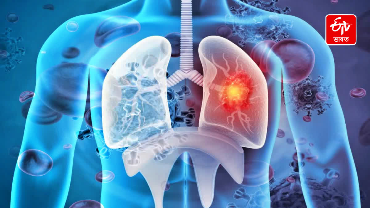 LUNG CANCER DIAGNOSIS