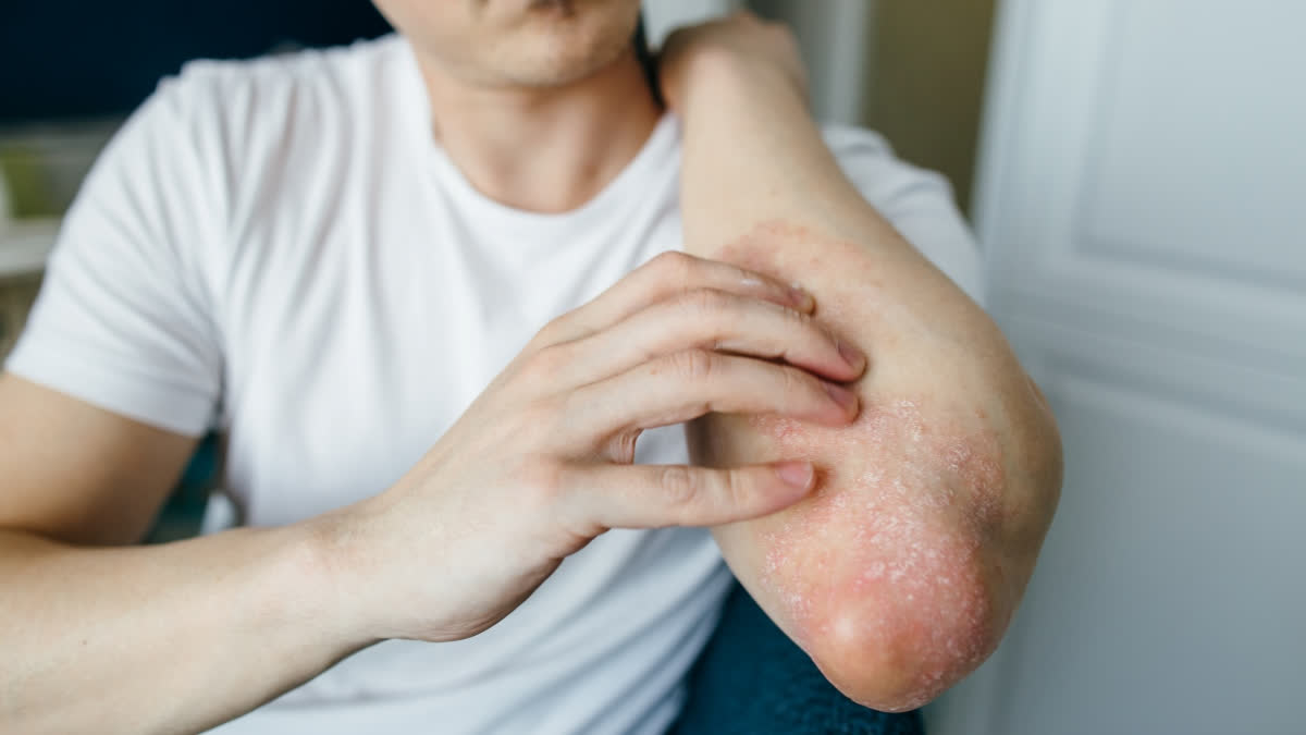 Fungal Infection: WHO Issues First Ever Report On Tests And Treatment WHO Issues First Ever Report On Tests And Treatment (Representational Image)
