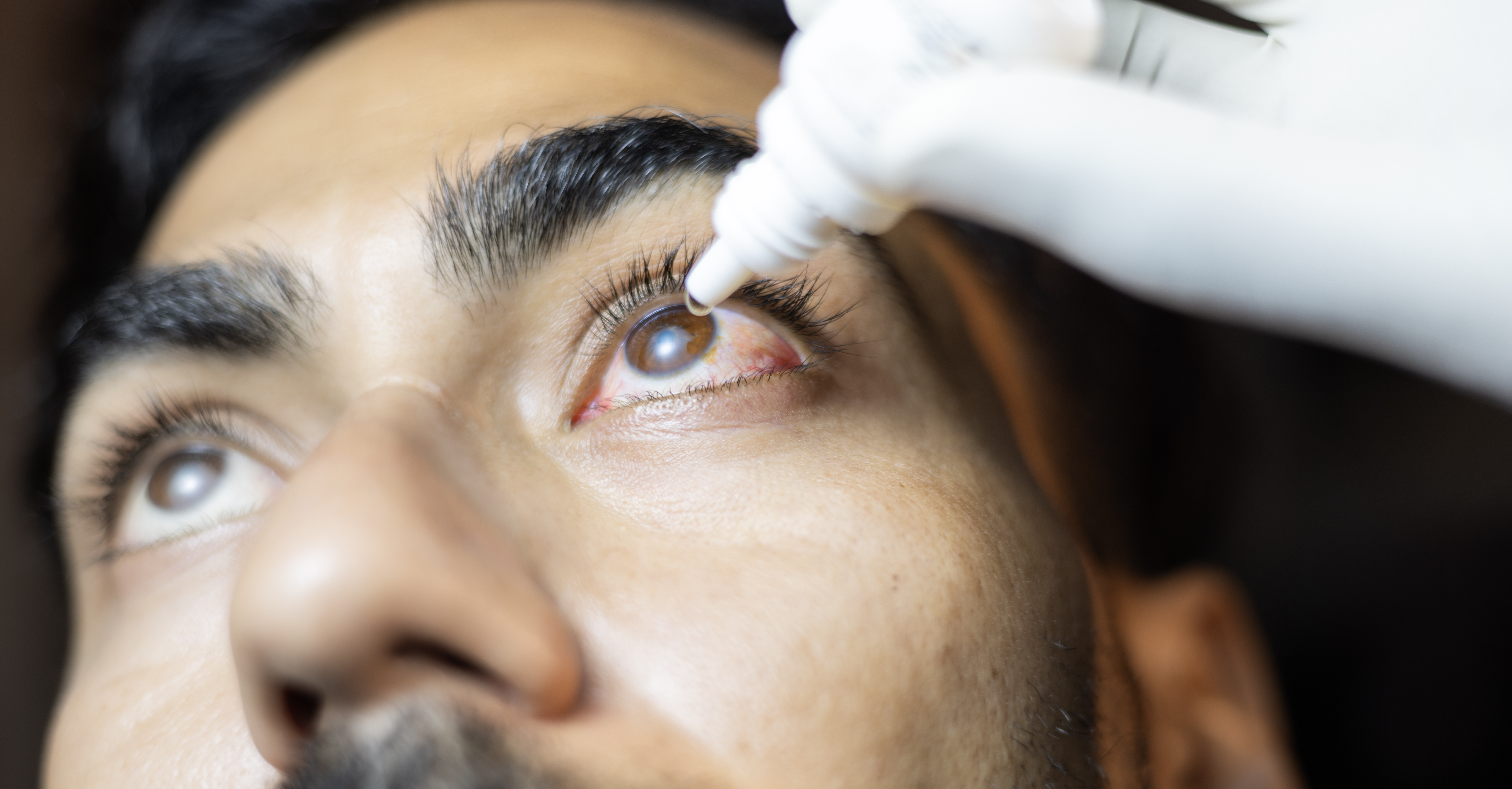 Steroid eye drops for an extended period can cause injury to the eye (Representational Image)
