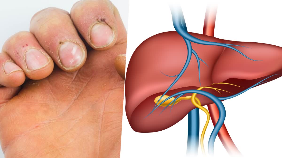 Liver Disease Symptoms From Nails
