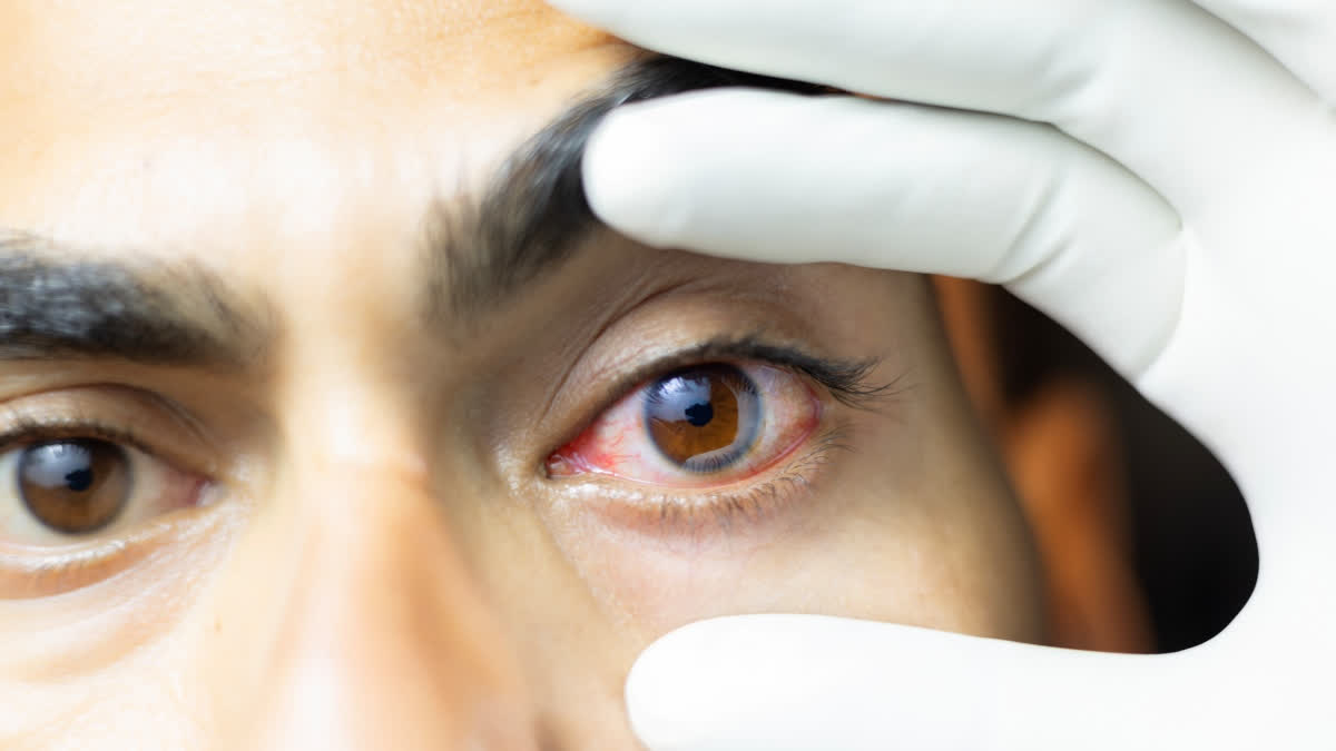 When Your Eyes Burn After Screen Time, Is It Just Eye Strain or Dry Eye Disease? Know the Difference and What to Do Man with dry eyes