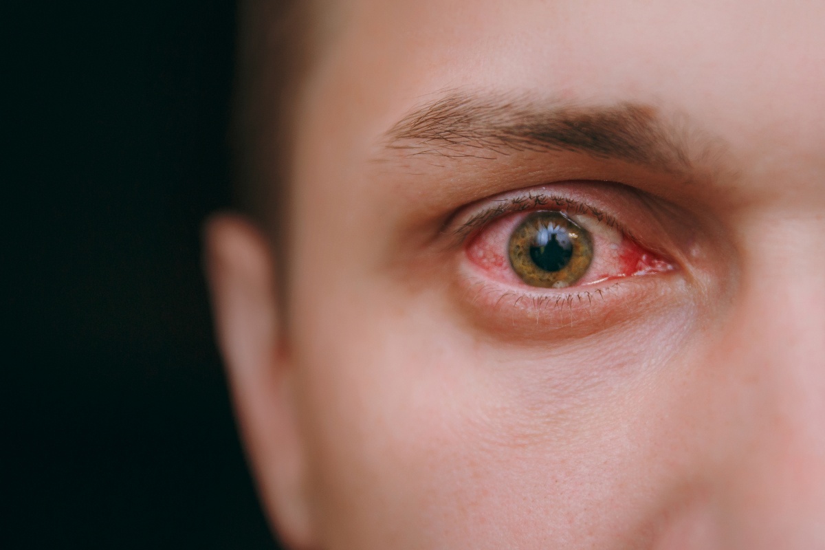 Man with red eyes