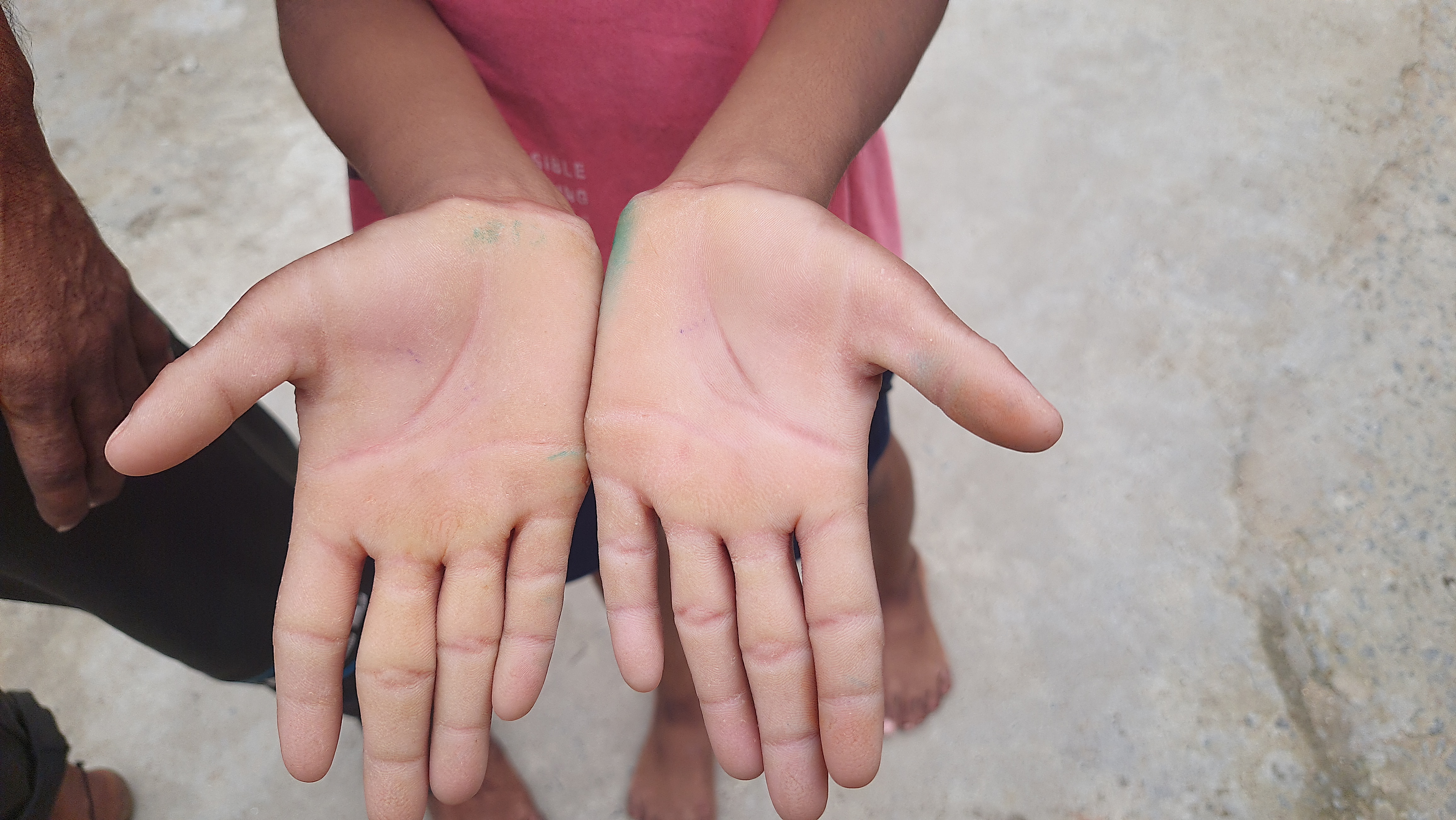 No Fingerprints No Aadhaar
