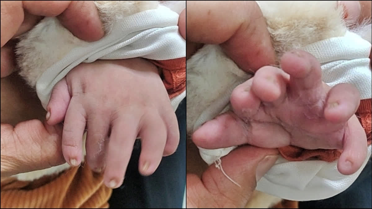The newborn has six fingers on both hands