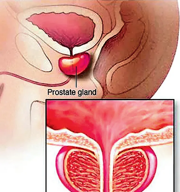 prostate cancer in men