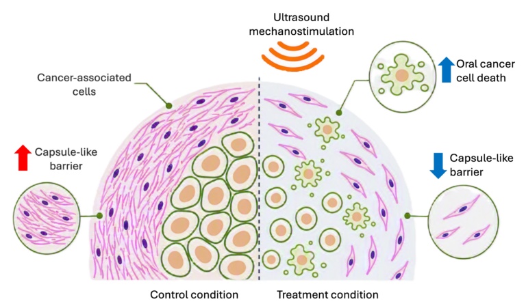Ultrasound mechanostimulation-mediated killing of oral cancer cells and compromised integrity of the capsule-like barrier