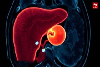 PREGNANCY RARE CASE  INTRAHEPATIC ECTOPIC PREGNANCY  UP UNIQUE PREGNANCY CASE  UTERINE EMBRYO FETUS