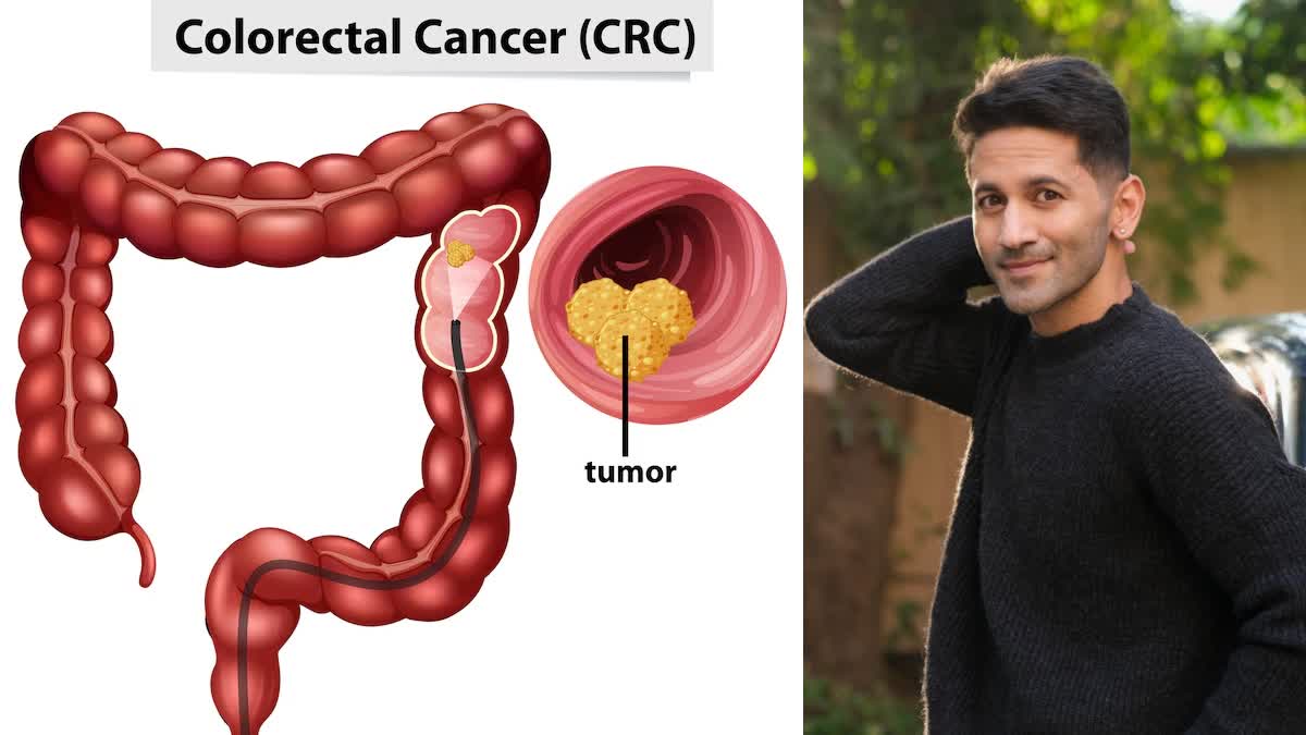Vibhu Raghave's Tragic Death Highlights the Silent Killer: Warning Signs of Colon Cancer Men Often