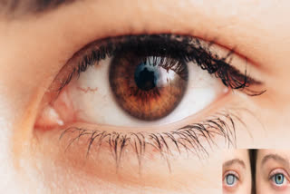 GLAUCOMA VS CATARACTS