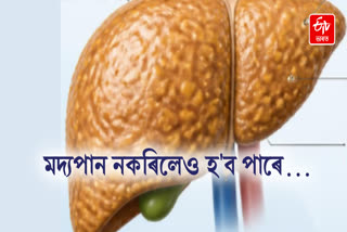 FATTY LIVER MASLD