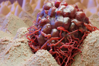 Who is at the highest risk of blood cancer? Learn about the symptoms of this incurable disease.