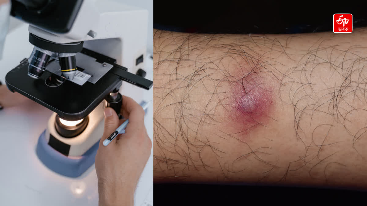 How dangerous is cellulitis in a person with diabetes?