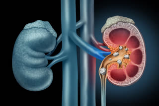 ECURRENT KIDNEY STONES