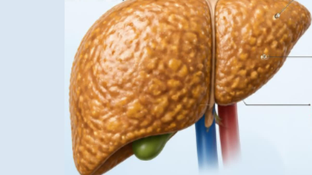FATTY LIVER WITHOUT ALCOHOL