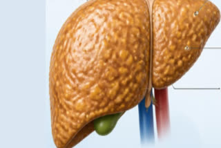 FATTY LIVER WITHOUT ALCOHOL