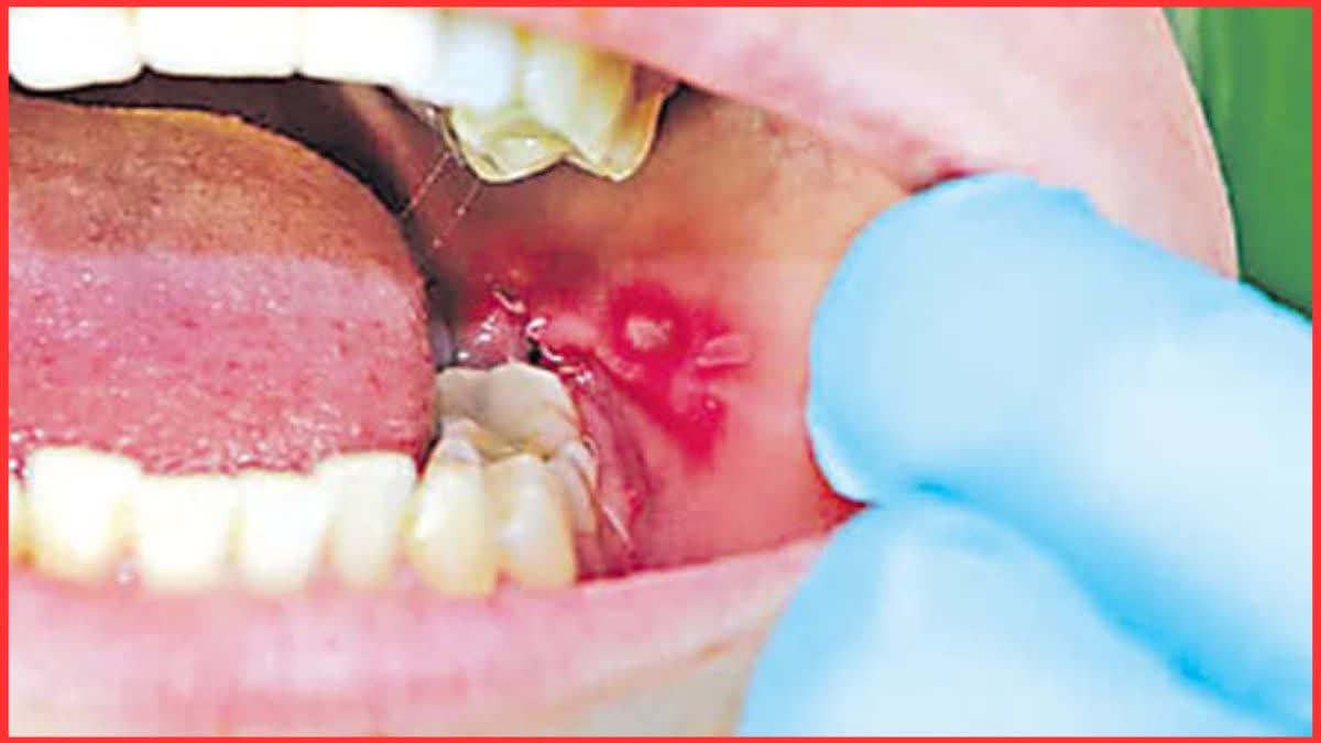 Oral Cancer to Be Curbed Mega Camps in Jind