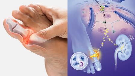 URIC ACID LEVELS STILL NOT REDUCING  WHAT IS HYPERURICEMIA  CAUSES OF HIGH URIC ACID LEVEL  ಯೂರಿಕ್ ಆ್ಯಸಿಡ್ ಸಮಸ್ಯೆ
