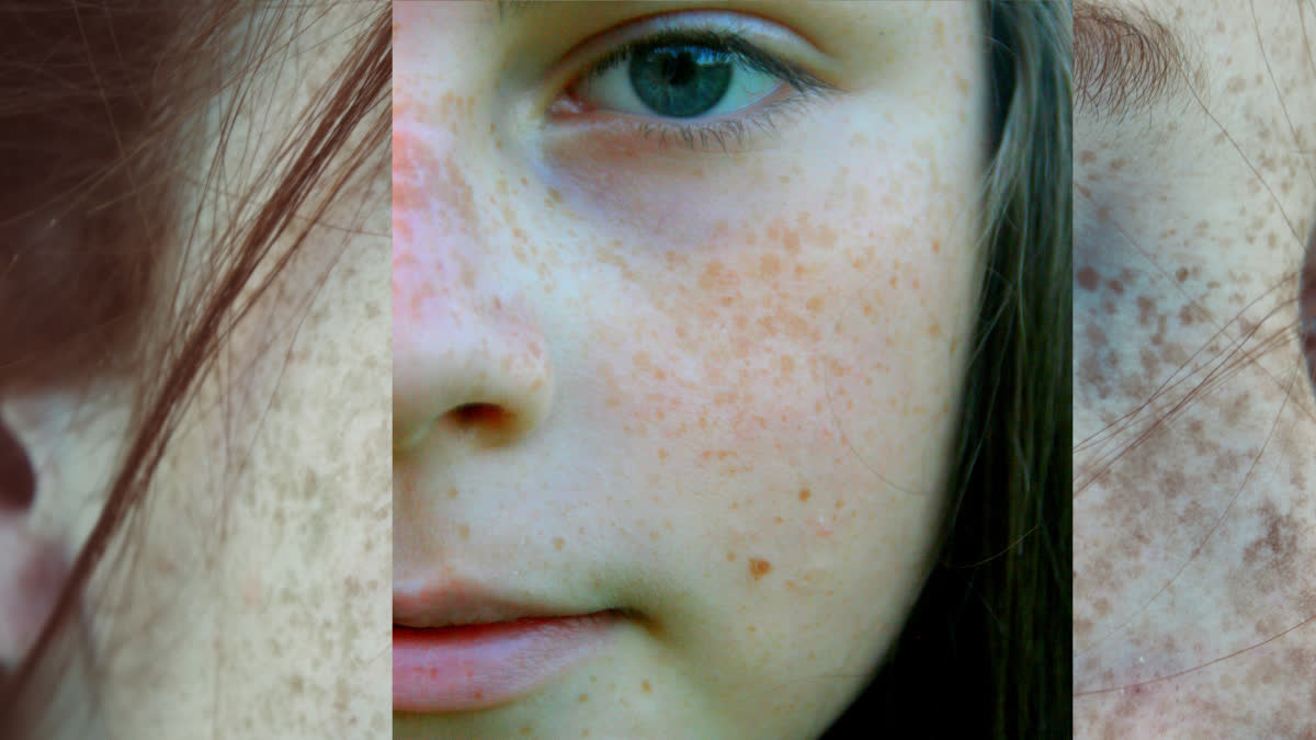 What are the signs of a rare and severe disease like Xeroderma Pigmentosum? Learn about its symptoms and preventive measures.