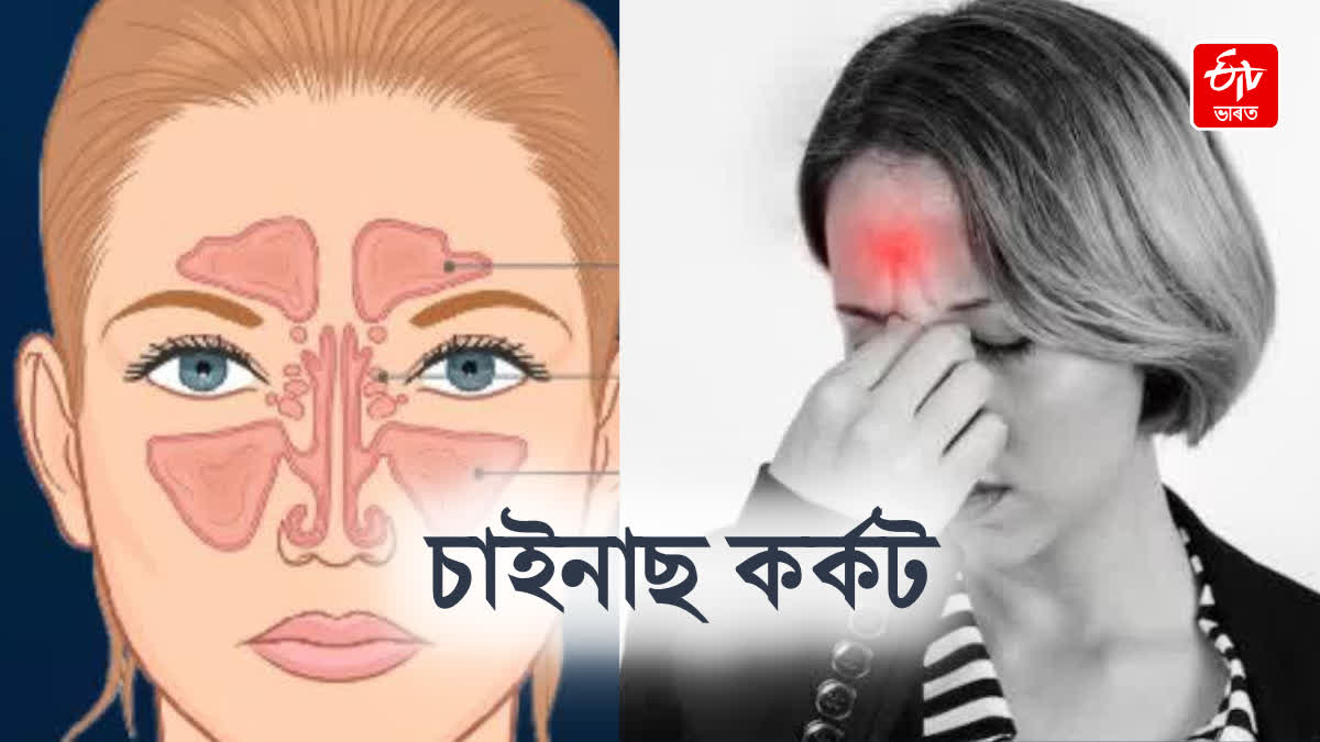 Know about the nasal cancer