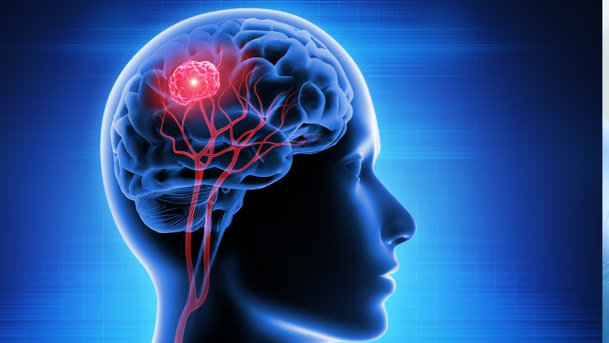 WORLD BRAIN TUMOUR DAY