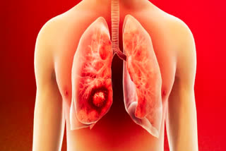 How air pollution, diet, stress, and a sedentary lifestyle can affect the risk of lung cancer.
