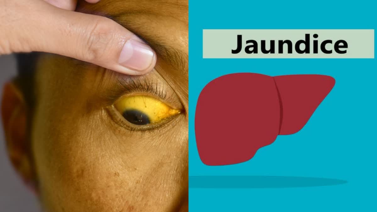 JAUNDICE