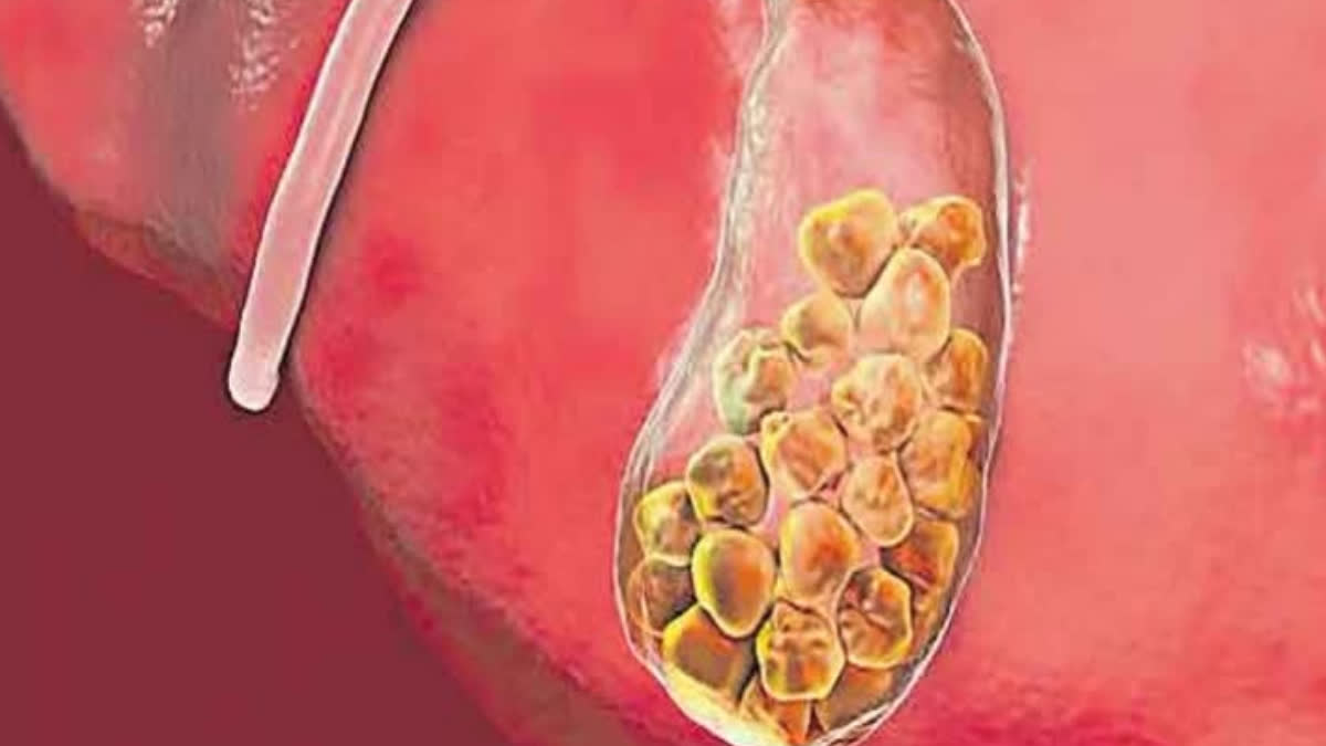 SYMPTOMS OF GALLSTONES  ALLSTONES OR BILE STONE  WHY DO GALLSTONES FORM  GALLSTONES