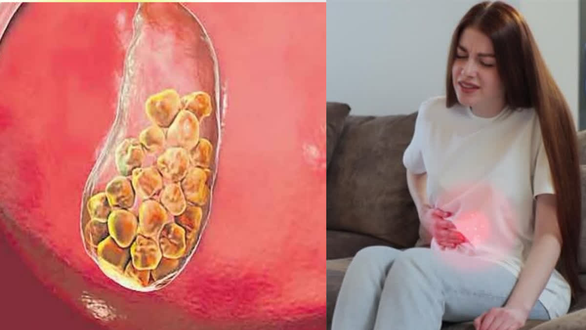 SYMPTOMS OF GALLSTONES  ALLSTONES OR BILE STONE  WHY DO GALLSTONES FORM  GALLSTONES