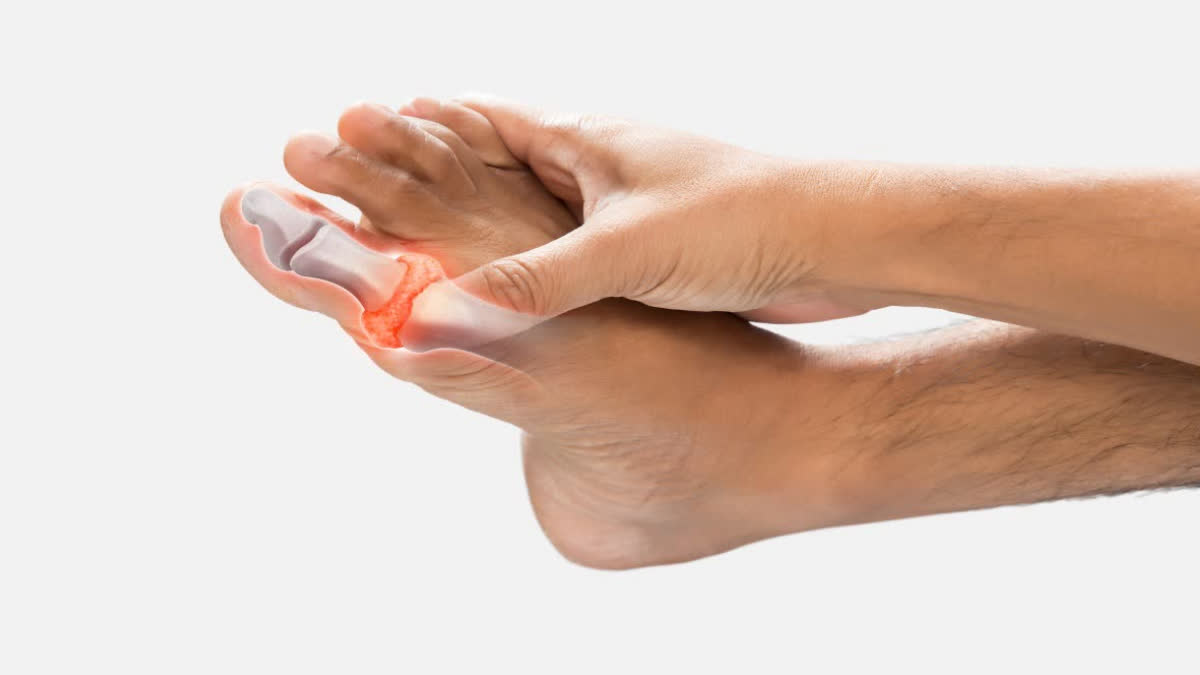 URIC ACID PAIN RELIEF FOOD