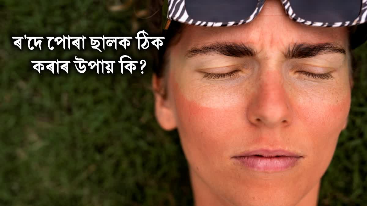 HOME REMEDY FOR SUNBURN