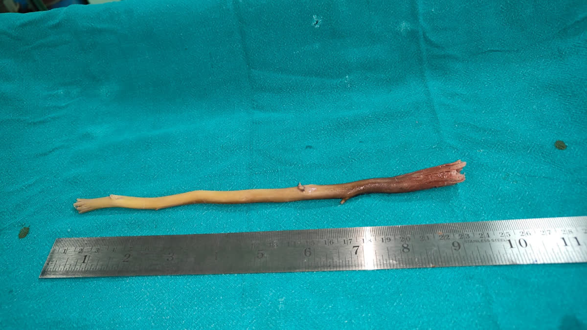 Nine-Inch ‘Tooth-Cleaning Stick’ Surgically Removed From 80-Year-Old Man’s Food Pipe