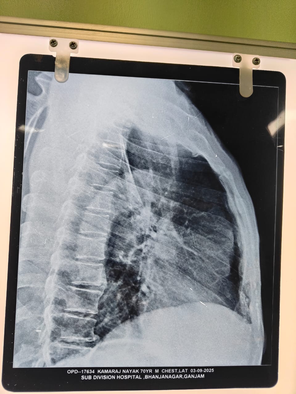 Nine-Inch ‘Tooth-Cleaning Stick’ Surgically Removed From 80-Year-Old Man’s Food Pipe
