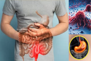 What are the signs of stomach cancer in the first stage and its treatment?
