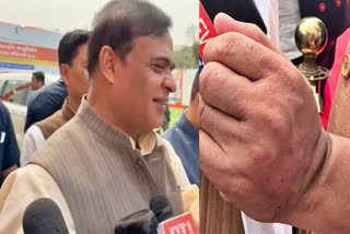 Himanta Biswa Sarma described nail scratches on his hands as scratches of affection
