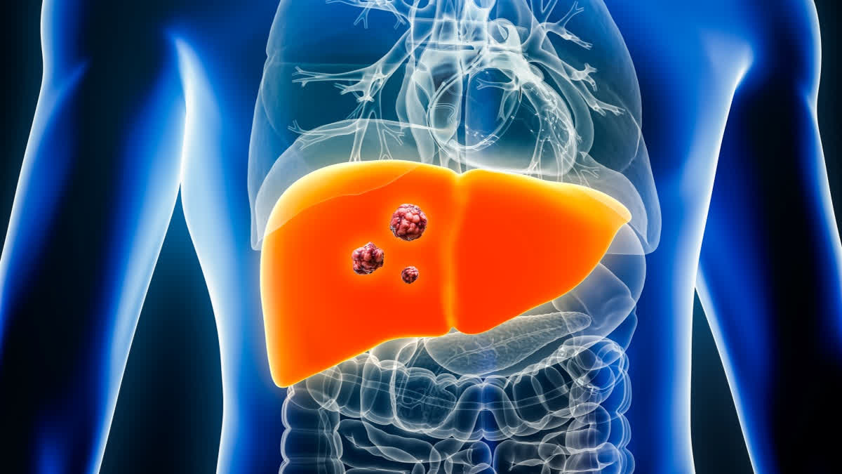 Liver cancer