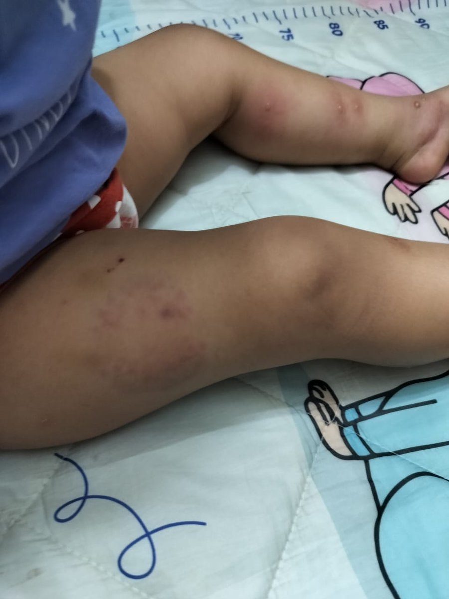 The bite marks on the victim's thigh.