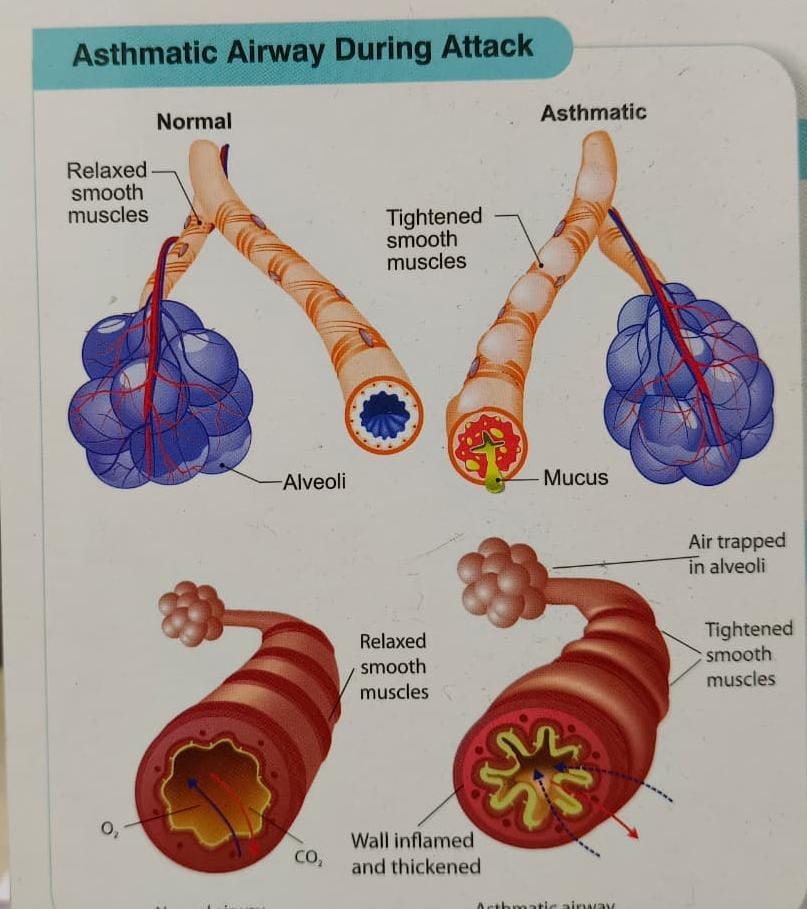 દિવાળી અને શિયાળામાં અસ્થમાનો વધતો પ્રકોપ: કારણો, લક્ષણો અને બચાવના ઉપાયો