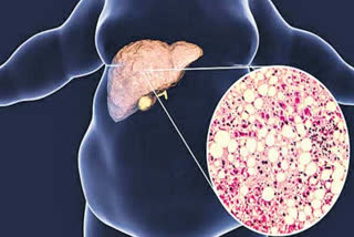 What are the symptoms and causes of fatty liver? Find out from Gastroenterologist Saurabh Sethi.