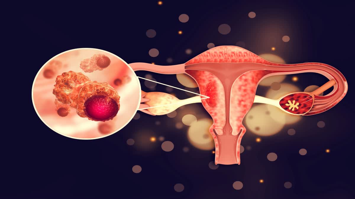 OVARIAN CANCER  OVARIAN CANCER SYMPTOMS  CAUSES OF OVARIAN CANCER
