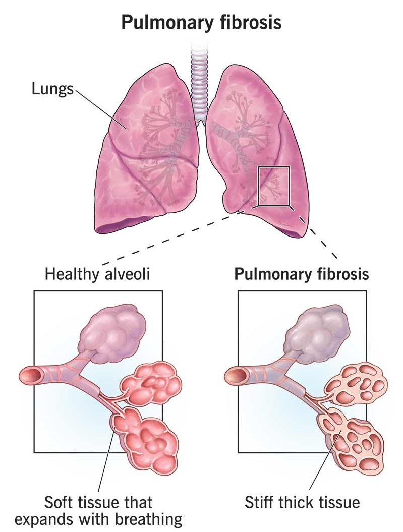 Lung Pulmonary Fibrosis: Symptoms and Causes Explained