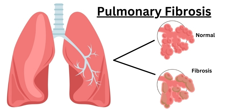 Lung Pulmonary Fibrosis: Symptoms and Causes Explained