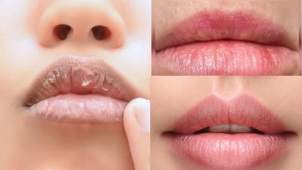 Why do lips crack so often in winter? Learn which vitamin deficiency causes this problem.