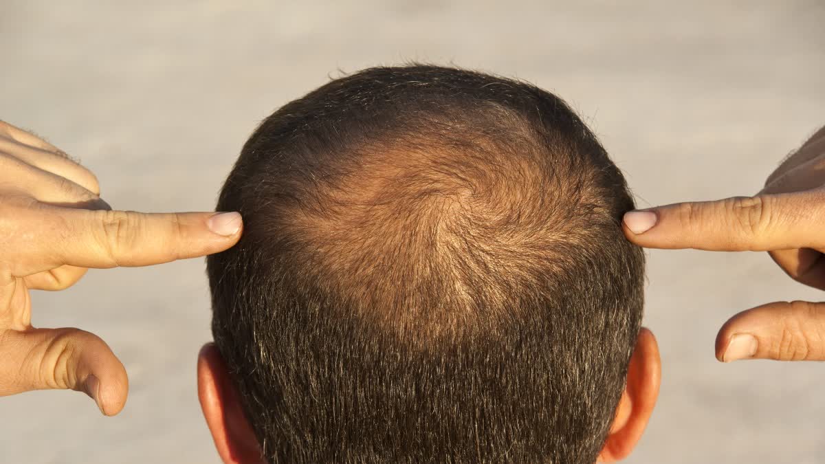 அதிகமா முடி கொட்டுதா? ஆண்களே உஷார்!