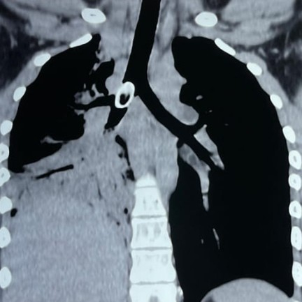 NRS SAVES TEENAGE GIRL LIFE