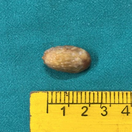 NRS SAVES TEENAGE GIRL LIFE