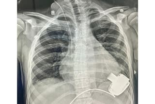 Mechanical Heart Implant In Boy