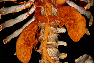 RENAL ARTERY STENOSIS SYMPTOMS