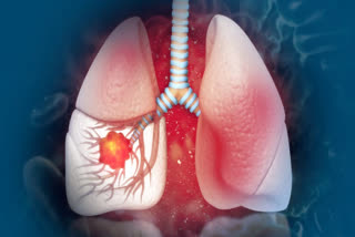 LUNG CANCER  IS SMOKING REASON FOR LUNG CANCER  LUNG CANCER RISK FOR INDIANS  ಶ್ವಾಸಕೋಶದ ಕ್ಯಾನ್ಸರ್