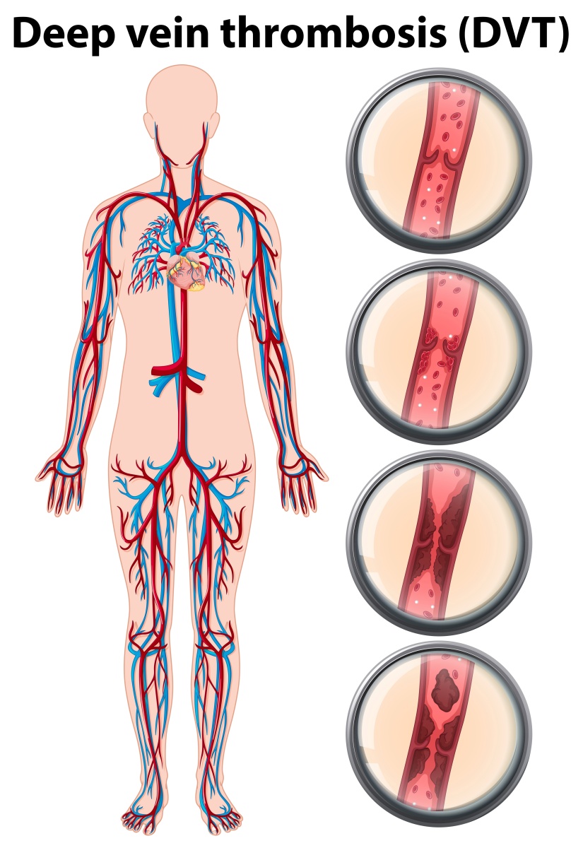 Deep Vein Thrombosis